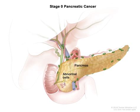 Pancreatic Cancer Treatment (PDQ®) - NCI