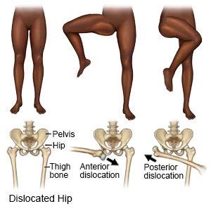 Hip Dislocation - What You Need to Know