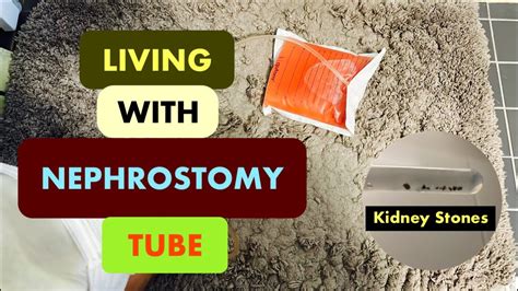 Nephrostomy Tube | Nefrostomi | Nephrostomy Journey | Nephrostomy Tube Care | Nephrostomy Tips ...