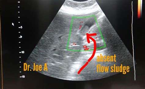 Ultrasound imaging: Gallbladder sludge 3D sonography