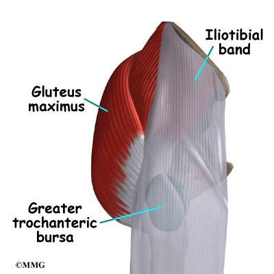 Trochanteric Bursitis Surgery - eOrthopod.com