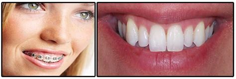 Teeth Whitening After Braces Removal - Dental News Network