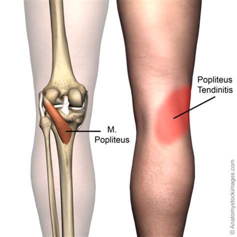 The Popliteus, the Tiny Muscle of Knee Pain!