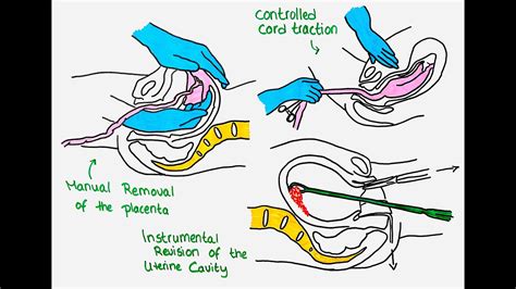 Manual Remove Of Placenta