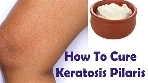 5 Miracle Home Remedies for Keratosis Pilaris | How to cure Keratosis ...