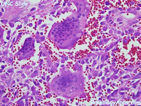 Giant Cell Tumor Histology