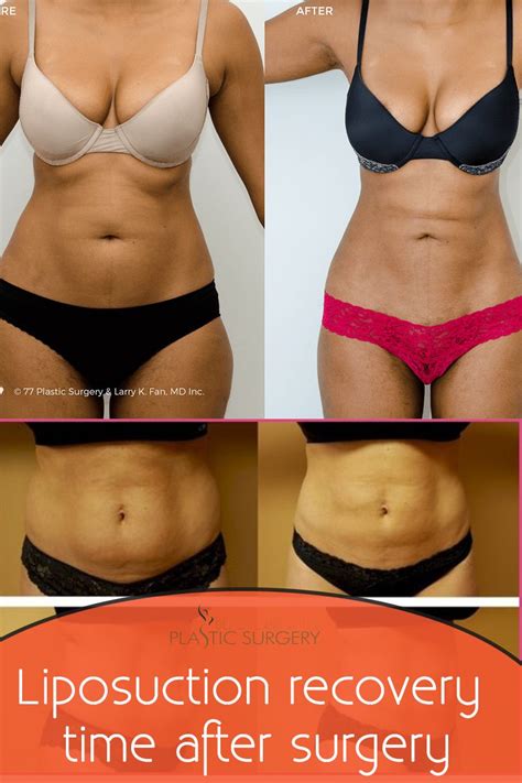 Liposuction recovery time after surgery | Liposuction recovery, Liposuction recovery time ...