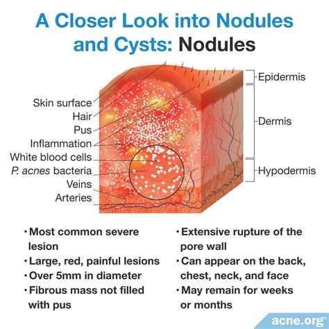 Cystic Acne on the Body - Acne.org