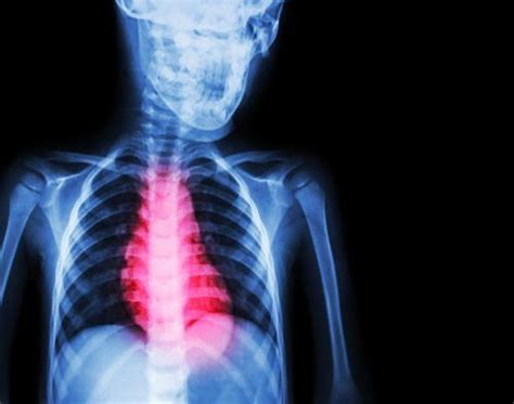 How to treat ischemic cardiomyopathy? Causes, symptoms, and prognosis