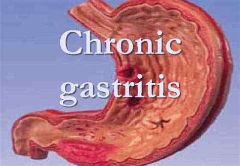 Natural Treatment for Gastritis - Philadelphia, PA Patch