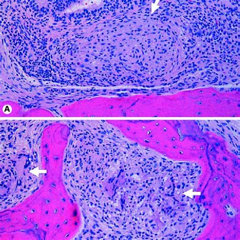 Case 3: histopathology of the right mastoid bone demonstrates... | Download Scientific Diagram