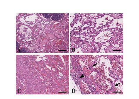 Representative histopathological findings of hemangiomas (A, B) and ...