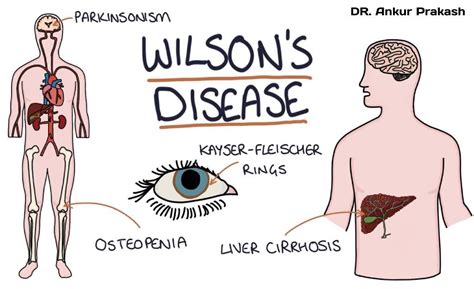 Homeopathic Approach for Wilson's Disease: Rare Genetic Disorders