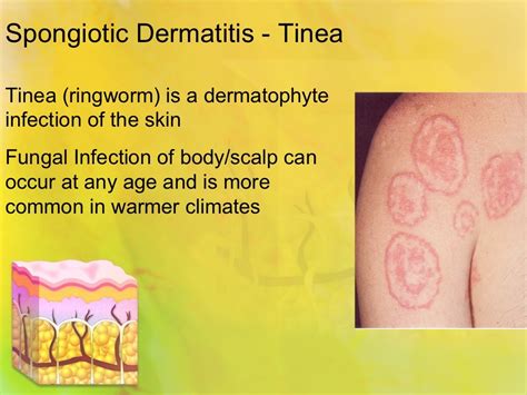 Spongiotic dermatitis tinea