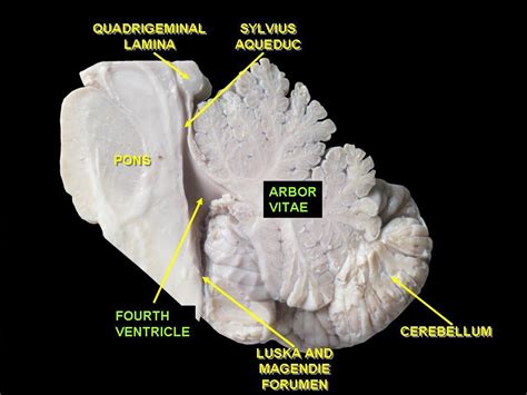 Cerebellar Nuclei; Dentate Nucleus; Nucleus Dentatus; Nucleus ...