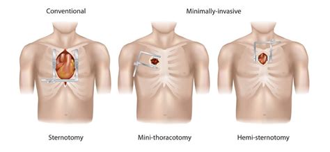 Cardiothoracic Surgery - Minimally Invasive Aortic Valve Surgery