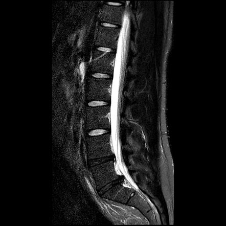 Annular Fissure Causes