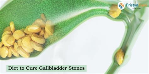 Diet to Cure Gallbladder Stones - What to eat in Gallstones