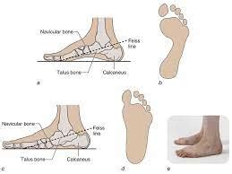 Pes Planus - Cause, Symptoms, Treatment, Exerccise