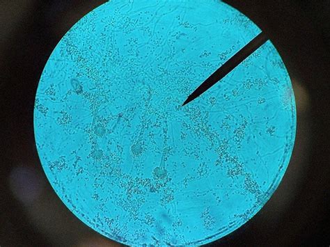 Fungal sinusitis: Symptoms, causes, types, and treatments