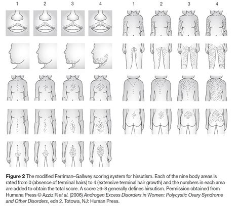 Ferriman Gallwey - Scoring system for Hirsutism