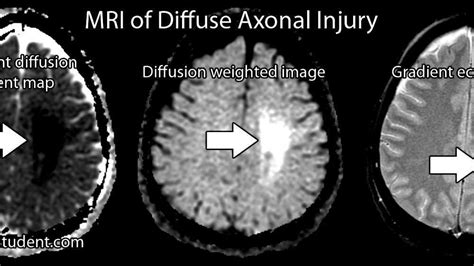 Diffuse axonal injury