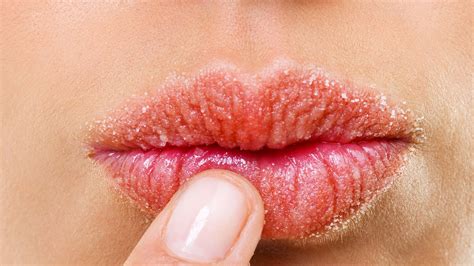 How To Treat Eczema On Your Lips | Glamour US