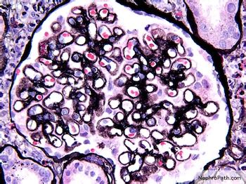 Nephropathy: Membranous Nephropathy Stages