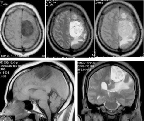 Microcystic meningioma – Radiology Cases