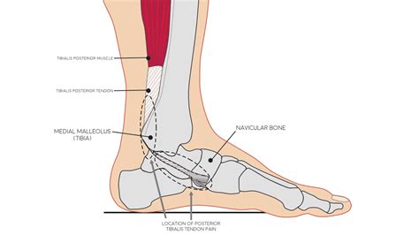 Posterior Tibial Tendon Insertion