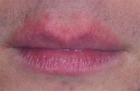 Lip Ailments & Repair Treatment | Seaside Medical Technologies