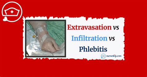 Extravasation vs Infiltration vs Phlebitis: Local Complications of Intravenous (IV) Therapy ...