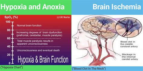 Brain Hypoxia and Anoxia Infographic - Infogram