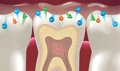 Dental Health Benefits of Fluoride Varnish