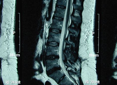 Tethered Cord Syndrome | Dr. Dan Heffez Neurological Surgeon