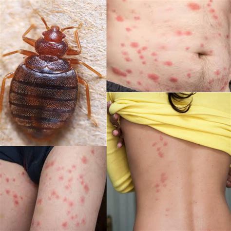 What Do Bed Bug Bites Look Like? (Pictured) - Public Health