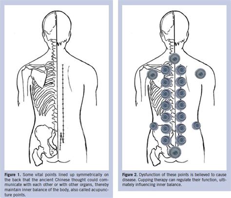 64 best hijama points images on Pinterest | Cupping therapy, Cupping massage and Acupressure