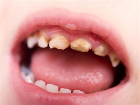 Tooth decay in children costing the NHS more than £40m a year, figures ...