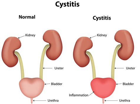 Common things about Cystitis and its herbal cure