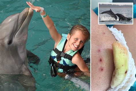 Aggressive dolphin attacks are on the rise as 10-year-old is mauled on family holiday – The ...