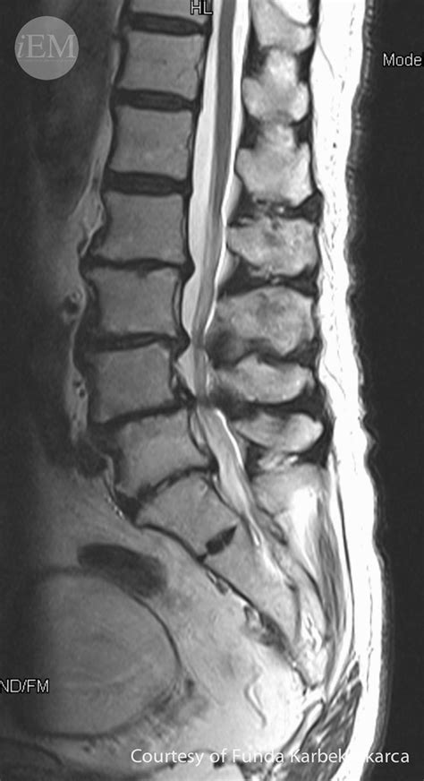 778.1 - Image 6. MRI. Lumbar L4-L5 discopathy | Emergency Medicine ...