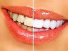 Smileactives Reviews: Ingredients, Cost and Does It Work? - Dentaly.org