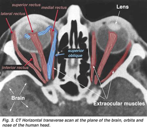 File:Extraocular-muscles-scan.jpg - Embryology