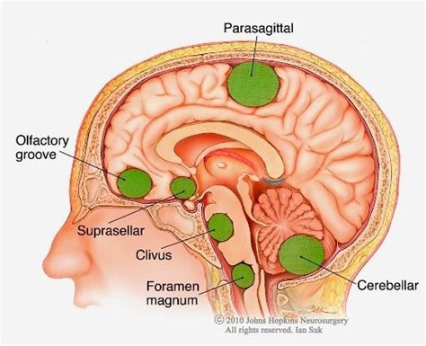 Pin on Brain tumor