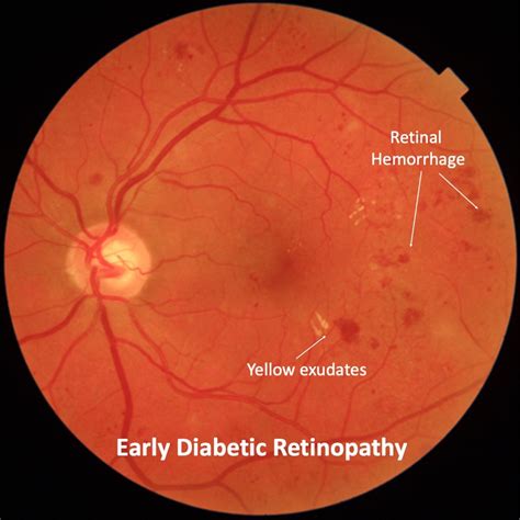 Diabetic Retinopathy | Mr Ellabban Eye Surgery | Yorkshire & Hull