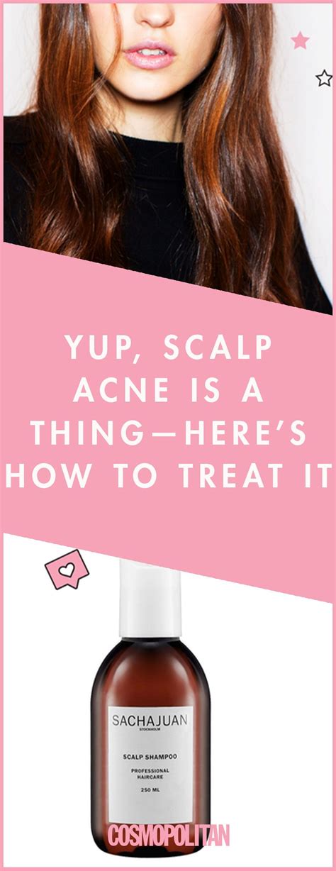 Soooo, You’ve Got Scalp Acne—Here’s the Shampoo You Need ASAP in 2021 | Scalp acne, Scalp acne ...