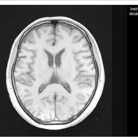 Brain MRI in 2016. No structural abnormality has been found | Download ...