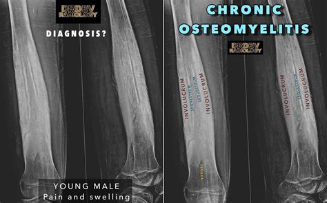 Osteomyelitis X Ray Features