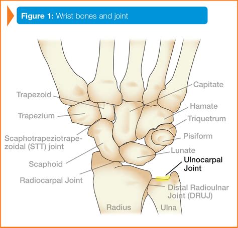 Ulnar Sided Wrist Pain Diagnosis And Treatment - Captions Trending Update