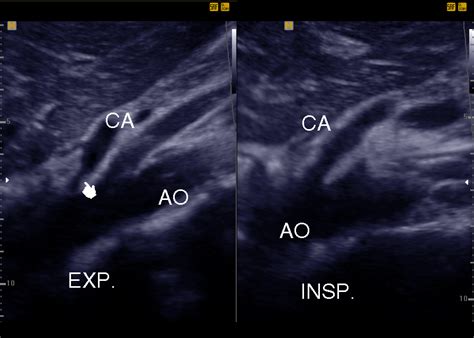 Evaluation of Asymptomatic Patients with Median Arcuate Ligament Syndrome (Mals) Using Color ...